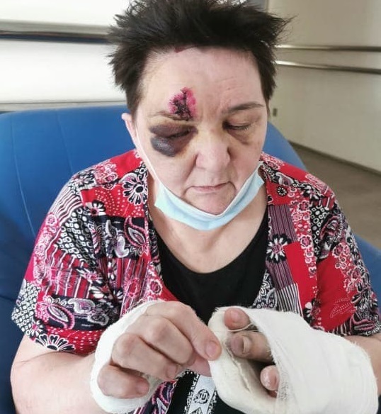 Дормидошина после операции в Боткинской больнице. Фото из ее архива