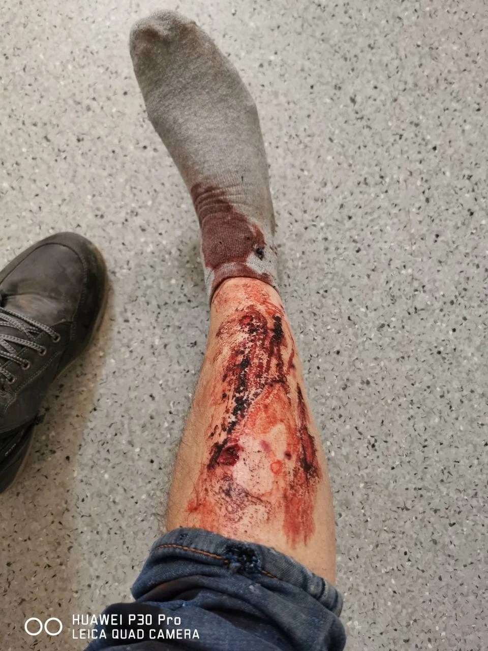 Ранение ноги. Фото с телефона Анатолия Геращенко