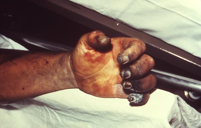 Рука, пораженная чумой / Wikimedia